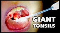 GIANT TONSILS + Strep Throat | Dr. Paul - YouTube