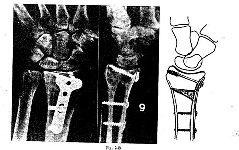 Pdf Correction Of Post Traumatic Wrist Deformity In Adults By