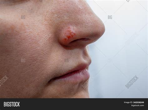 Herpes On Nose Image And Photo Free Trial Bigstock