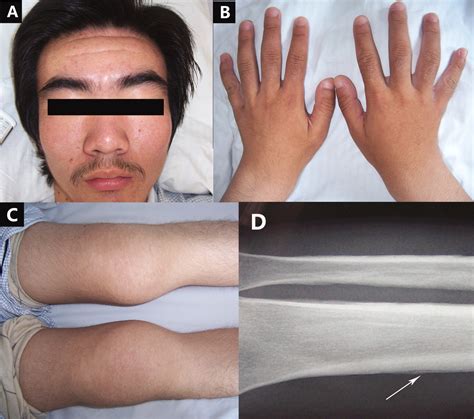 Primary Hypertrophic Osteoarthropathy With Gastric Hypertrophy The