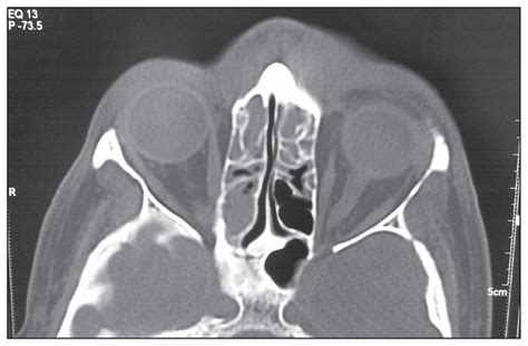 Pott Puffy Tumor A Rare Complication Of Sinusitis Annals Of Saudi