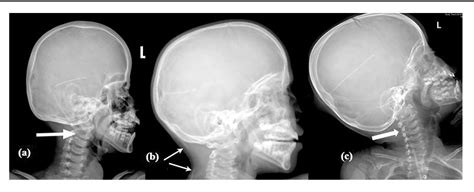 Figure 3 From Is Shunt Series X Ray Necessary Before Revision Of