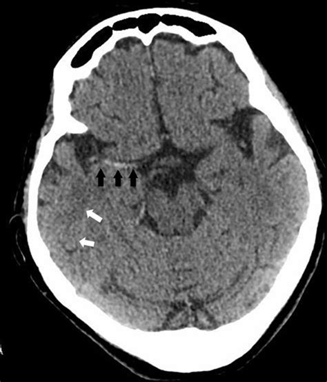 A Case Of Large Right Mca Stroke With Hyperdense Mca Sign In Ct Imaging