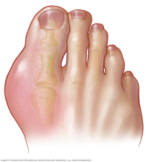 Gout Disease Reference Guide