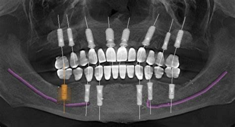 How Many Implants In The Edentulous Maxilla Spear Education