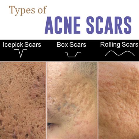 Acne scars fall into two main categories: Types of Acne Scars | Aesthetic Clinic Singapore | Medical ...