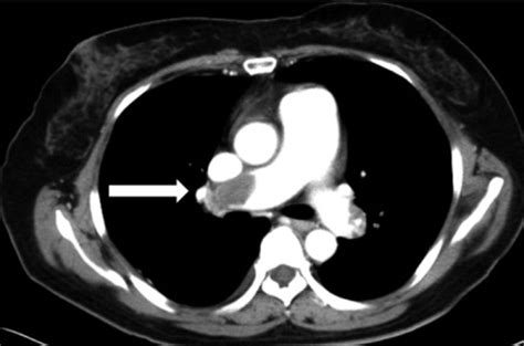 Chest Ct Angiography Shows Acute Pulmonary Embolism Ar Open I