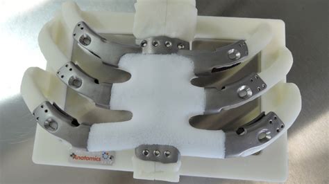 First Us Patient Receives 3d Printed Sternum And Partial Rib Cage