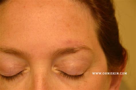 Skin Cancers Involving The Eyebrow Clinical Considerations
