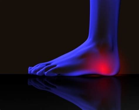 Acupuncture For Plantar Fasciitis The Acupuncture Clinic