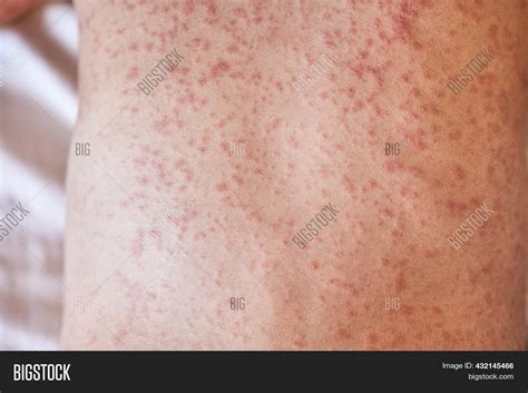 Allergic Rash On Body Image And Photo Free Trial Bigstock
