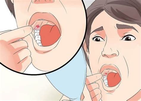 Tips for fast wisdom teeth removal recovery. How to Reduce Swelling After Wisdom Teeth Removal | Wisdom ...