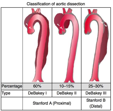 Aortic Dissection Type A And B Symptoms Causes Treatment