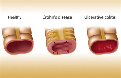 Inflammatory Bowel Disease And Cannabis A Field Report