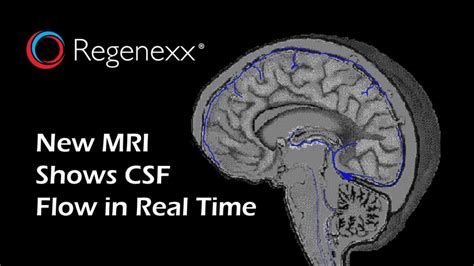 Using Mri To Measure Csf Flow In Patients With Ccj Instability Regenexx®