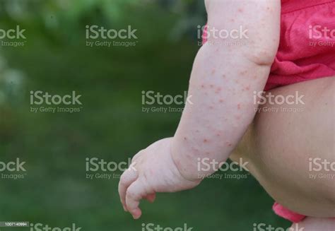 Baby Rash Caused By Fever Insect Bite Skin Allergy Or Heat Reaction