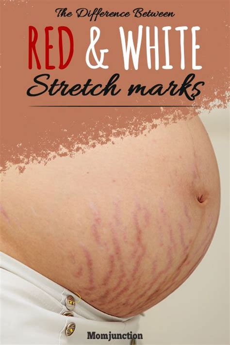 the difference between red and white stretch marks newbieto fitness