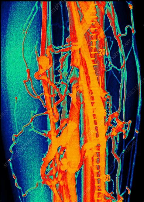Coloured Venogram Of Phlebitis In Leg Of Patient Stock Image M175