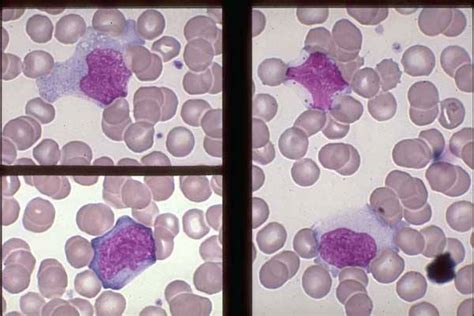 Differentiating Monocytes From Large Lymphocytes Medical