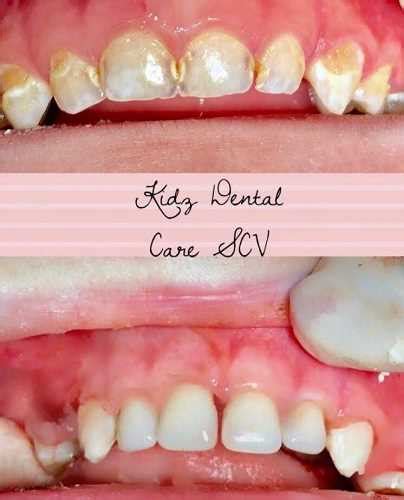 Why Should Cavities In Baby Teeth Need To Be Treated