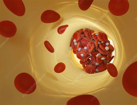 Blood Clot Illustration Stock Image F0418377 Science Photo Library