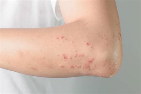 Sintomas Tratamento E Causas Da Dermatite Herpetiforme Medicamento My