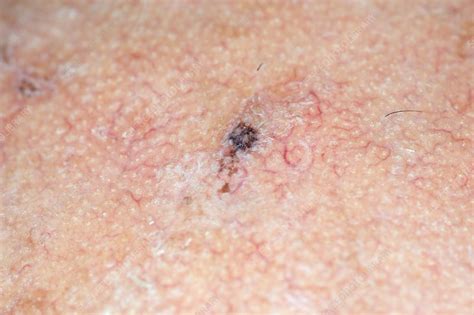 Seborrhoeic Wart On The Skin Stock Image C0197839 Science Photo