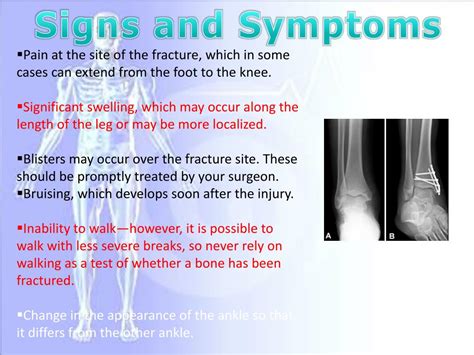 Ppt Ankle Fracture Powerpoint Presentation Free Download Id3744012