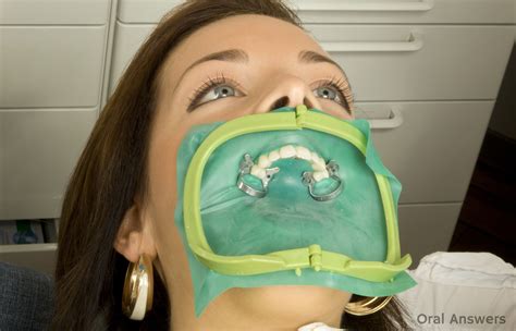 rubber dental dams what they are and why dentists use them oral answers