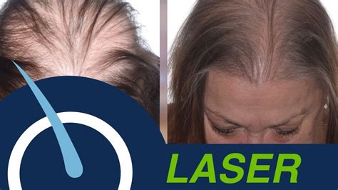 Women With Advanced Hair Loss Laser Therapy Youtube