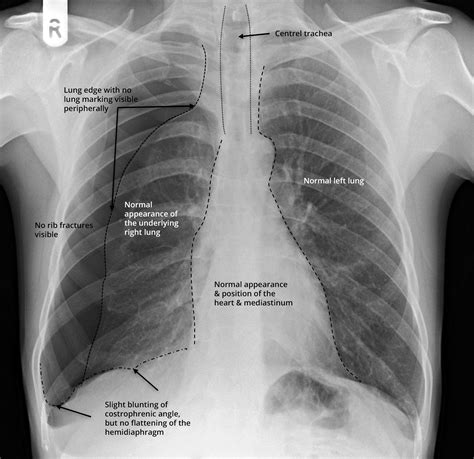 Is there any inhaled foreign body? The Unofficial Guide to Radiology
