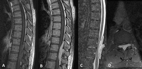 Preoperative Sagittal Magnetic Resonance Imaging Of The Spine Shows An