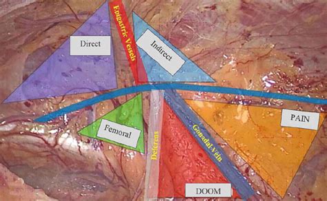 Anatomy Of Laparoscopic Inguinal Hernia Triangle