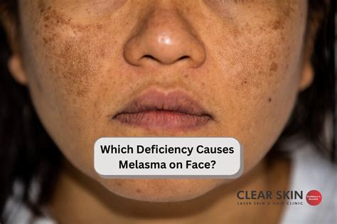 Which Deficiency Causes Melasma On Face
