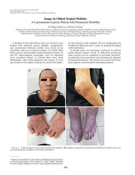 Pdf A Lepromatous Leprosy Patient With Permanent Disability