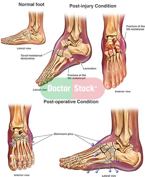 Left Foot Crush Injuries With Initial Surgical Fixation Doctor Stock