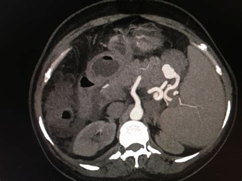 Pancreatitis With Splenic Artery Pseudo Aneurysm Radiology Imaging