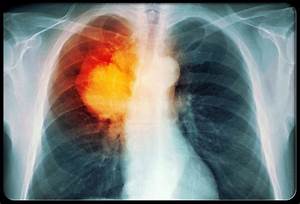 The Arts, Sciences and Medicine: Infection, Inflammation and Cancer Lung Cancer  