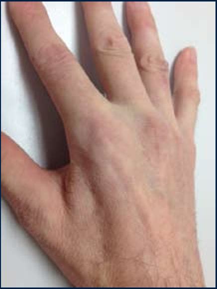 Cubital Tunnel Syndrome Diagnosis And Management Semantic Scholar