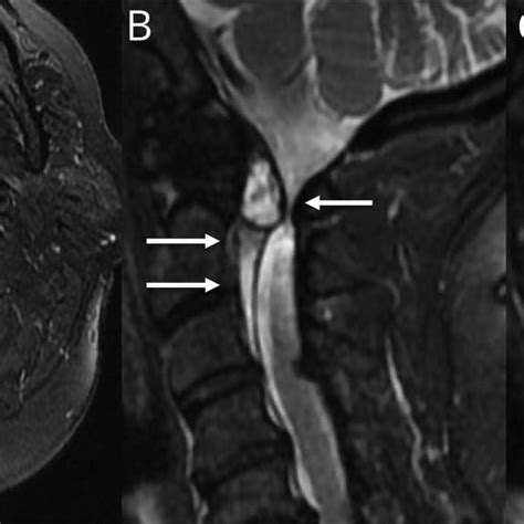 Figure MRI Of Spinal Cord Compression Caused By A Cervical Synovial