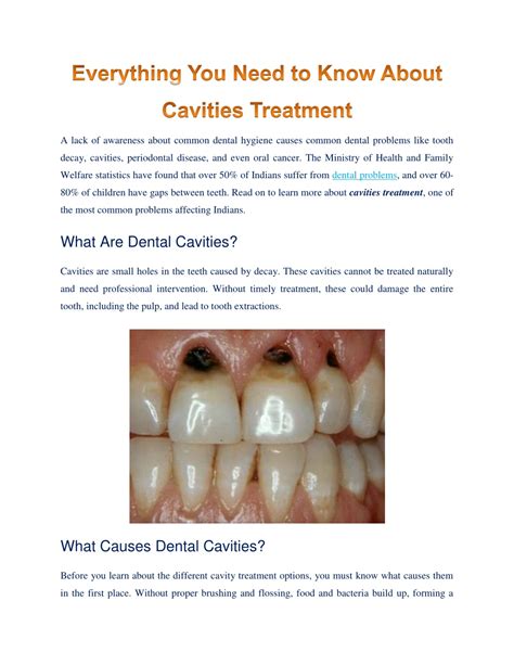 Ppt All That You Must Know About Cavities Treatment Powerpoint