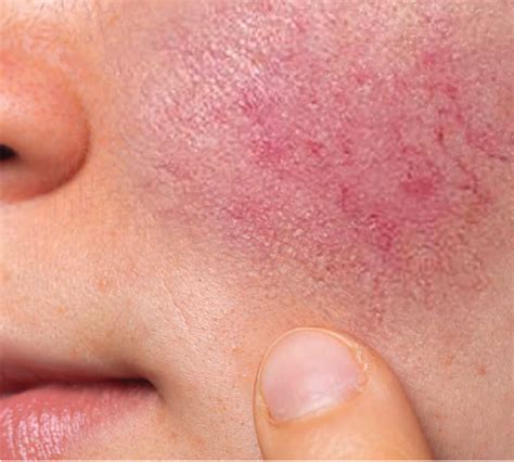 Helping Patients To Recognize Facial Redness The Dermatologist