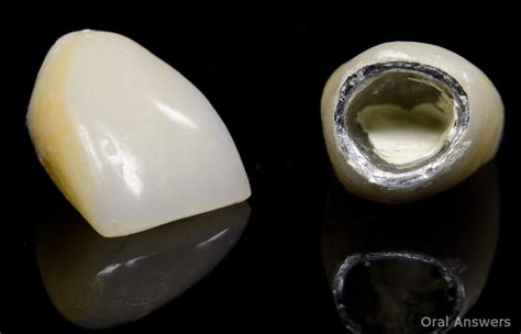 What You Should Do When A Crown Falls Off Of Your Tooth Oral Answers