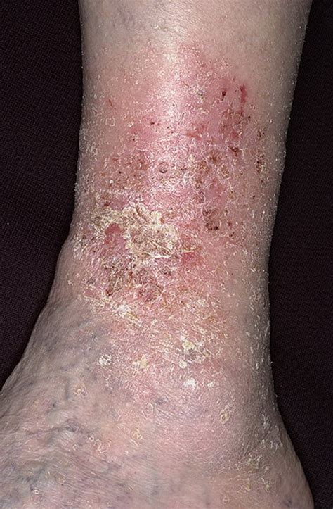 Stasis Dermatitis On Legs Pictures 174 Photos And Images