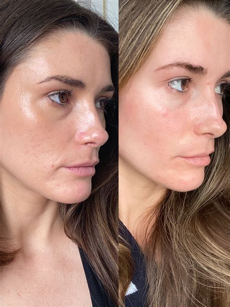 I Tried Radiofrequency Microneedling—heres My Honest Review Who What