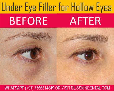 Best Under Eye Filler For Hollow Eyes And Tear Trough In Bandra Mumbai