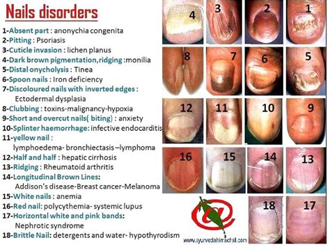 Disorders Of The Nails Nail Disorders Fingernail Health Nail Health