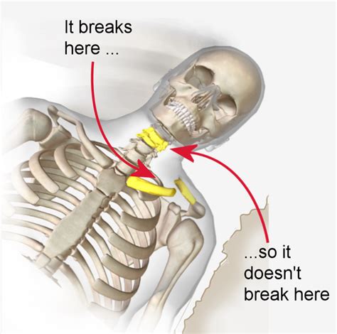 So she stopped and took to 'leaning' on one arm as she breathed only to one side, another factor that may have weakened her shoulder. Why is a clavicle easily fractured? - Quora