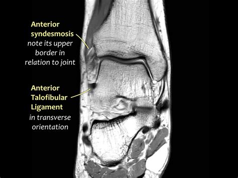 The Radiology Assistant Ankle Mri Examination
