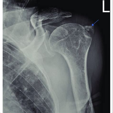 Antero Inferior Glenoid Rim Fracture After Anterior Glenohumeral